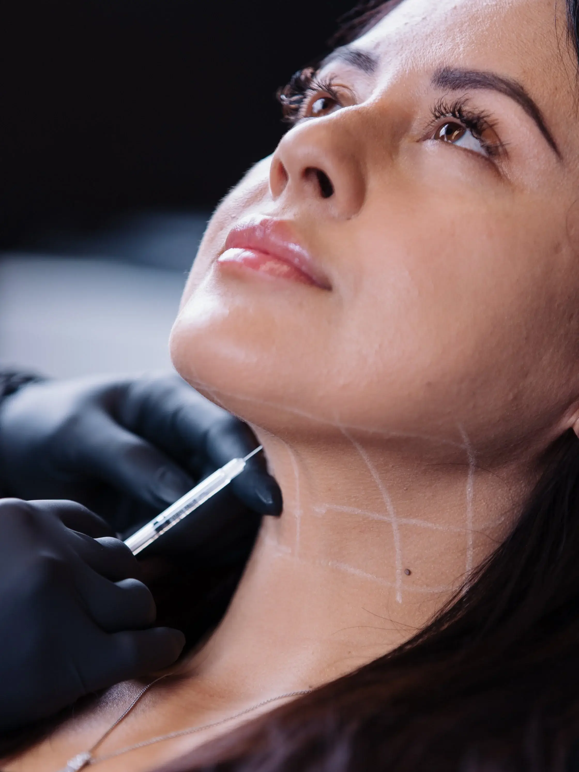 White guide lines mapped along a patient’s chin, jawline, and neck before injection