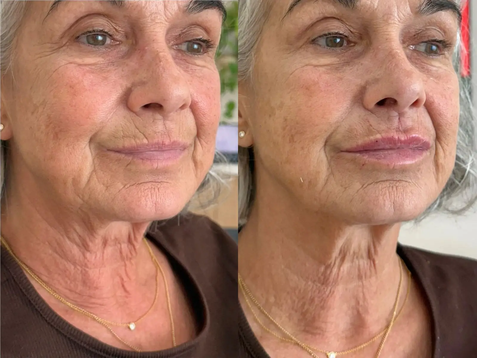 Two three-quarter views of the face, neck of a patient with grey hair