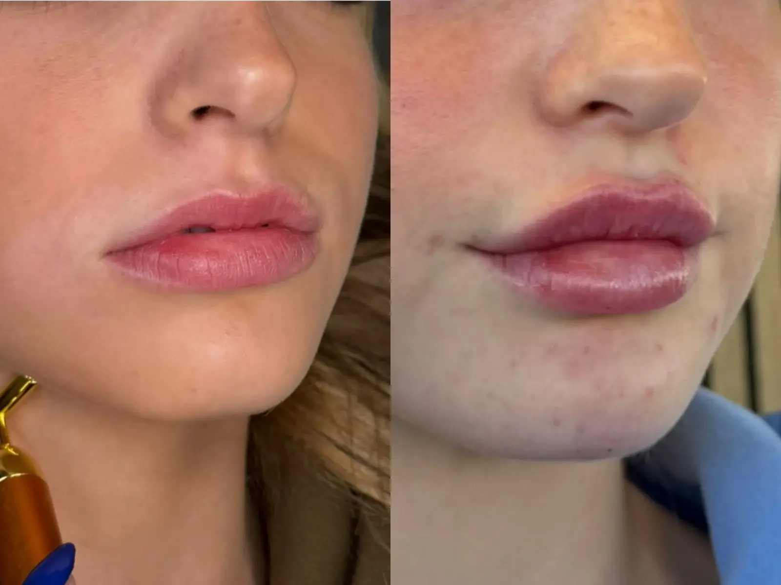 Two close views of the mouth, chin of one patient