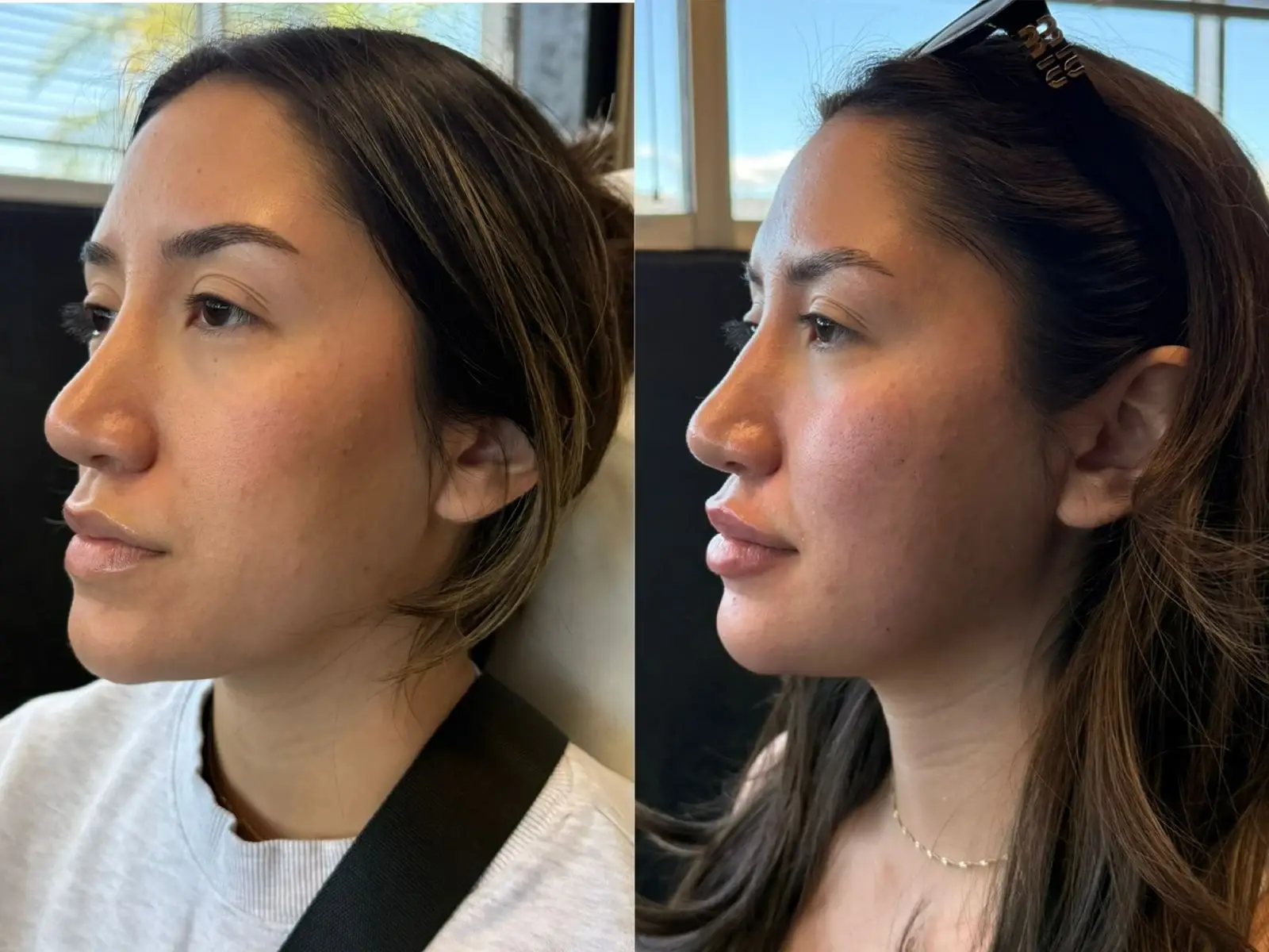 Two three-quarter views of the jaw, chin of one patient