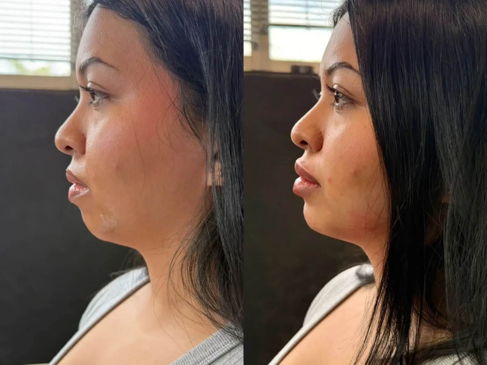 Two profile views of the jaw, chin, neck of one patient