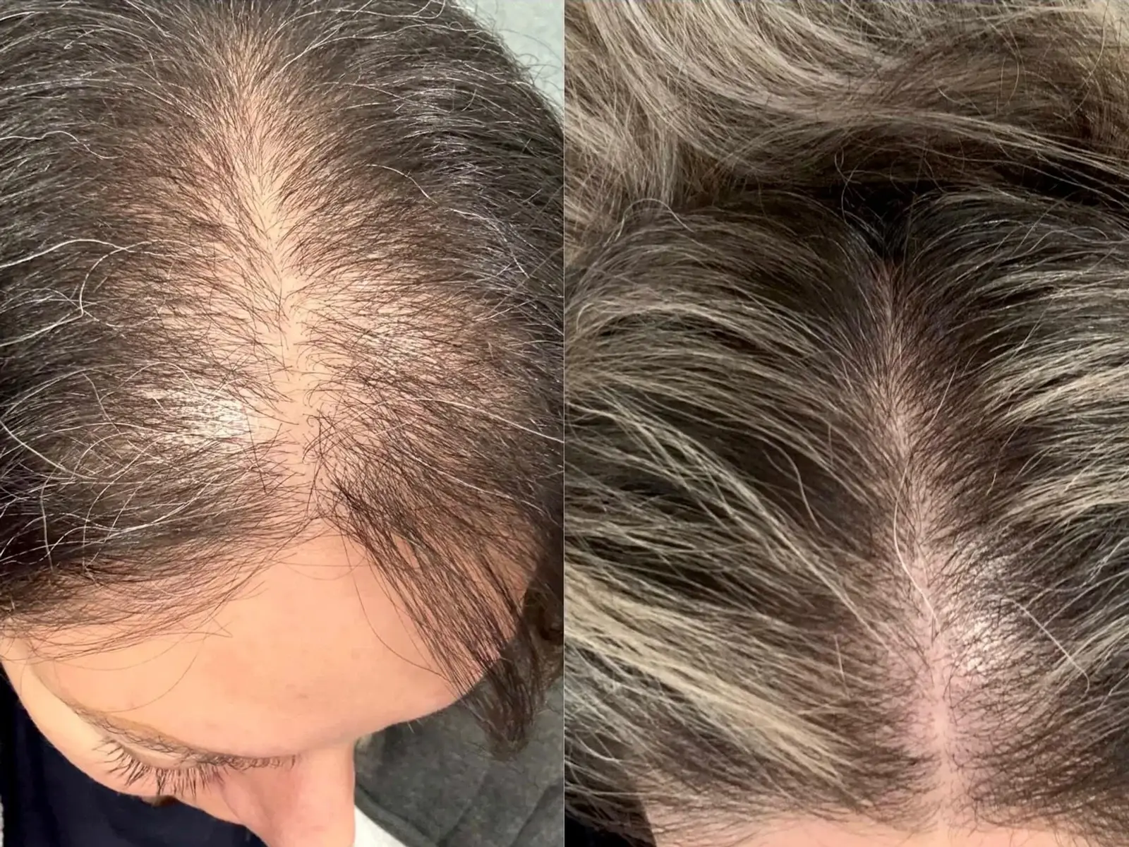 Two overhead views of the scalp along a centre parting