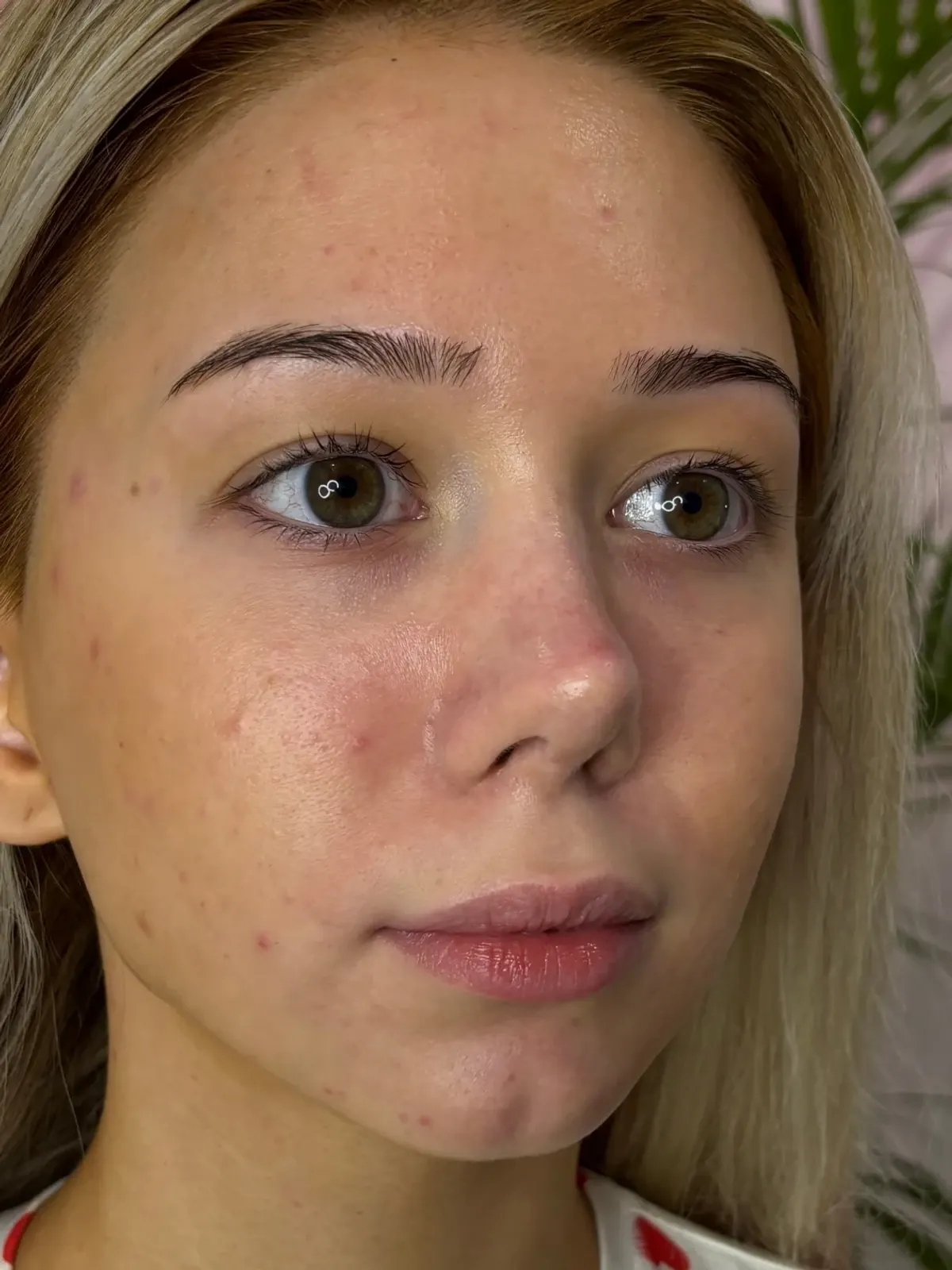 Patient in her twenties facing the camera, brows, cheeks, mouth filling the frame, before treatment
