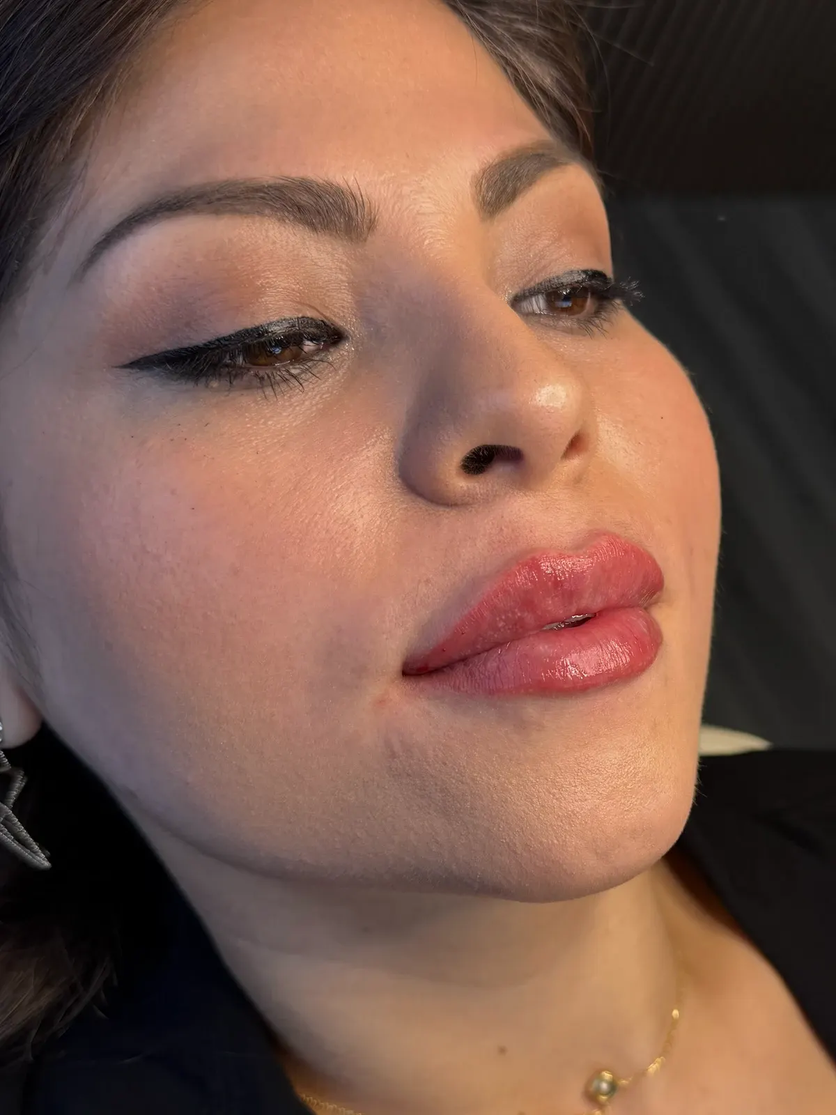 Patient reclined on the treatment bed, head turned, brow, cheek, lips in frame, after treatment
