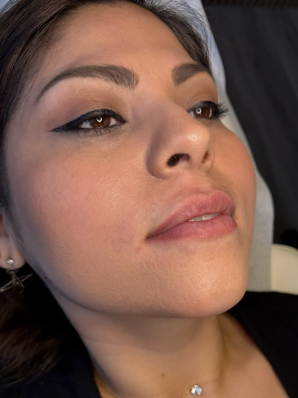 Patient reclined on the treatment bed, head turned, brow, cheek, lips in frame, before treatment